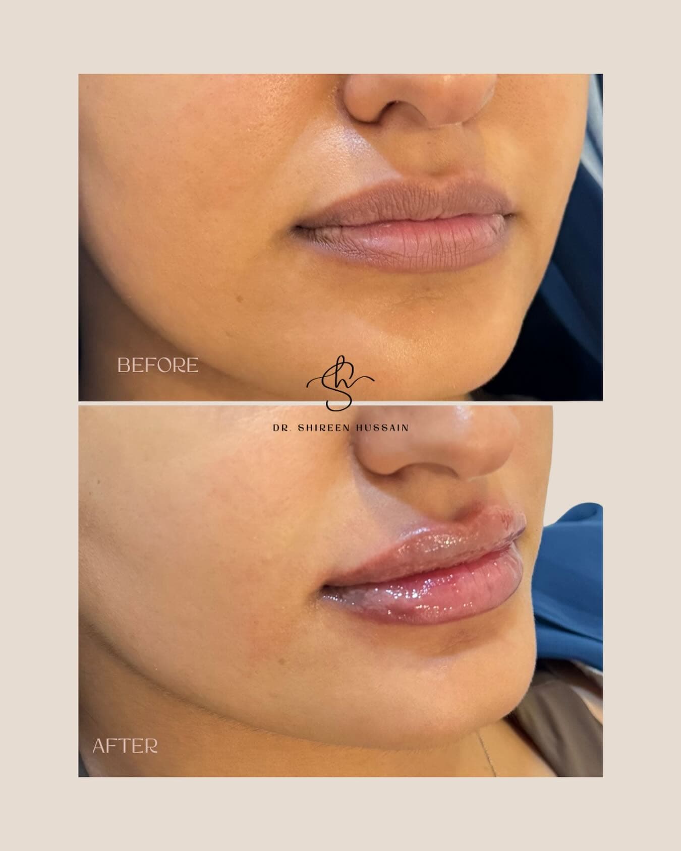 Lip Booster Treatment before and after